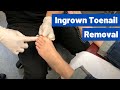 Ingrown Toenail Removal Surgery Video Permanent Cosmetic Procedure