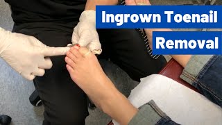 Ingrown Toenail Removal Surgery Video | Permanent, Cosmetic Procedure