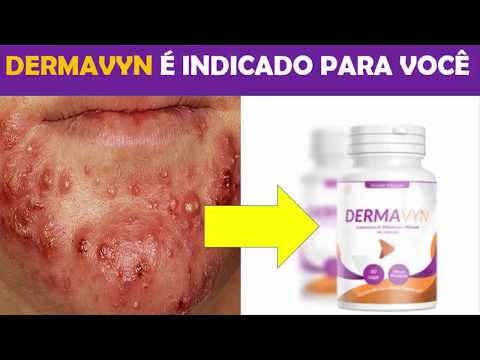 DERMAVYN FUNCIONA MESMO? ACABA COM A ACNE?