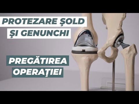 Tratamentul bilateral al gonartrozei genunchiului