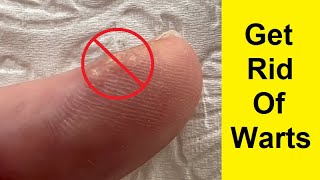How To Get Rid Of Warts