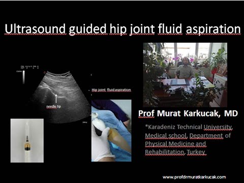 Ultrasound guided hip joint fluid aspiration