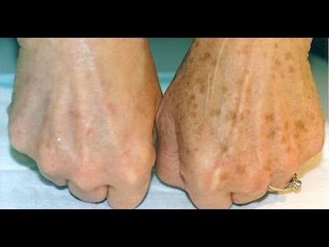 Отбеливание кожи лица народные средства эффективное Эффективное средство от пигментных пятен под глазами