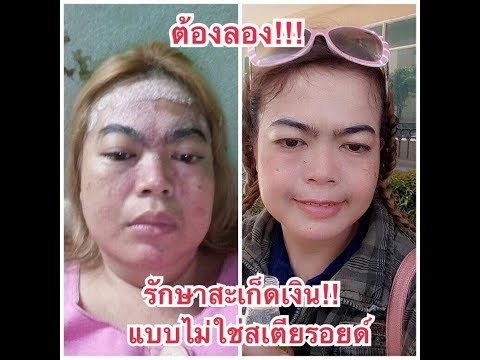 การเยียวยาชาวบ้านสำหรับครีมกลาก โรคสะเก็ดเงินและคุณลักษณะของมัน