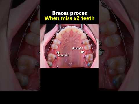Miss x2 molar teeth and braces #dentist #orthodontist #teeth #braces