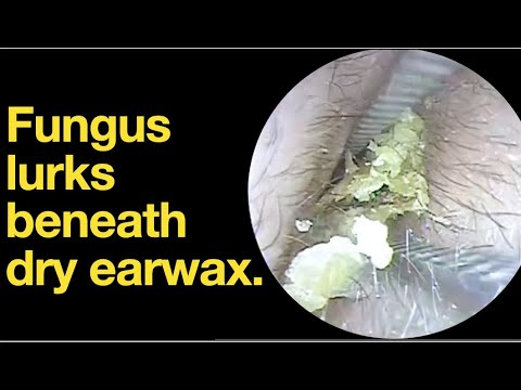 Fungus lurks beneath dry earwax. |ear wax removal | ear cleaning | ASMR | relaxation | relax