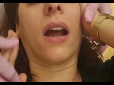 Wenn das Kiefergelenk knackt, ist oft der Diskus verrutscht.Hier sehen Sie eine Reposition.