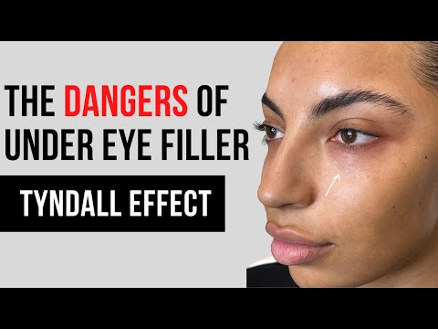 BOTCHED! Under Eye Filler Gone Wrong | Tear Trough Tyndall Effect