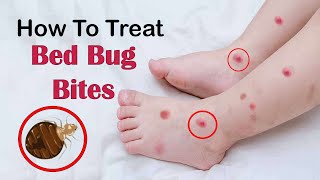 How to Treat Bed Bug Bites Fast at Home || Home Remedies for Bed Bugs Bites Treatment