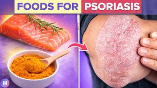 10 Foods That Help Fight Psoriasis and 4 To Avoid!