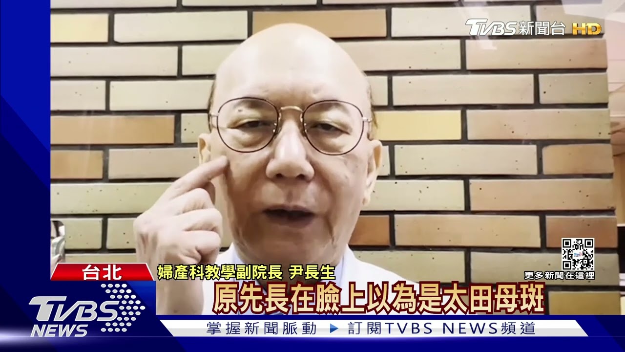 黃子佼爆「孟耿如為孩蒙古斑」哭整晚 醫:慢慢退