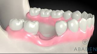 Injerto de hueso dental - Colocación de Implante dental con injerto de hueso