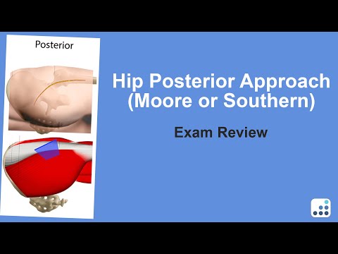Hip Posterior Approach (Moore or Southern) Exam Review - Doug Padgett, MD