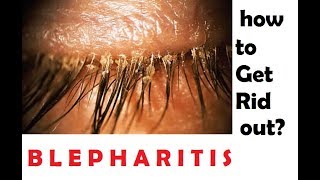 what is blepharitis? How to get rid out of this?(English)