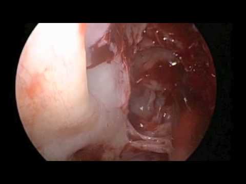 Ethmoidectomy, Polypectomy, Implanting and Stenting