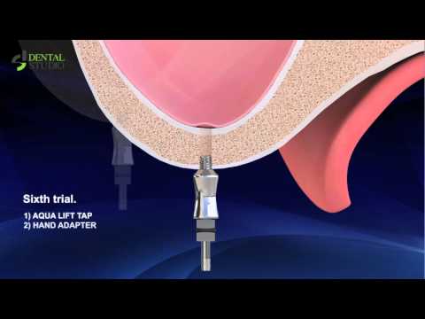 sinus crestal approach kit
