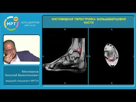 Дегенеративно-дистрофические заболевания голеностопного сустава