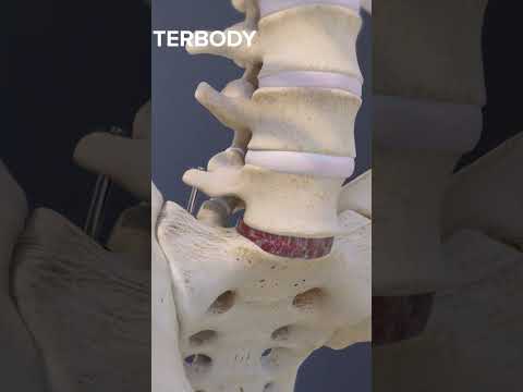 Advantages of an L5-S1 Anterior Lumbar Interbody Fusion