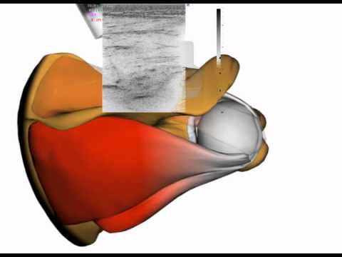 Shoulder intervention; Suprascapular injection under the ultrasound guidance