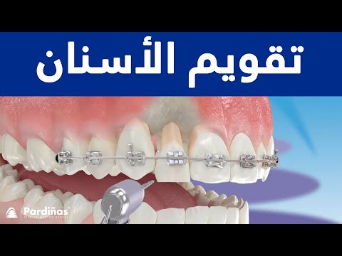 تقويم الأسنان ©