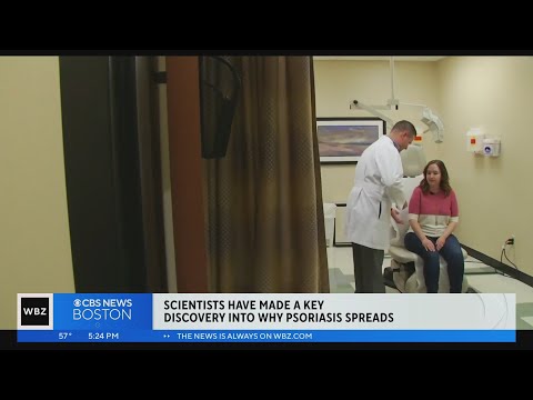 New discovery on how psoriasis spreads may lead to more effective treatments