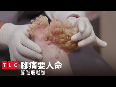 , title : '《腳痛要人命》腳趾珊瑚礁，醫生也沒有看過的驚人案例｜TLC 旅遊生活頻道'