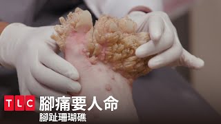 [問卦] 為什麼腳底會長這些軟組織