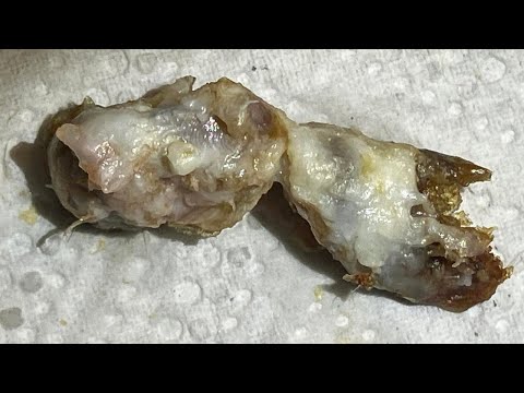 1,574 - Grade III Keratosis Obturans Removal