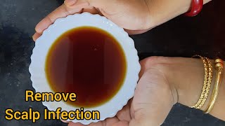 With Only 2 ingredients,remove all Scalp Infection || RitzTipz