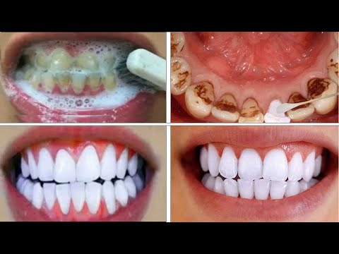 , title : 'Teeth Whitening At Home In 3 Minutes || How To Whiten Your Yellow Teeth Naturally || 100% Effective'