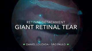 Retinal Detachment: Giant Retinal Tear