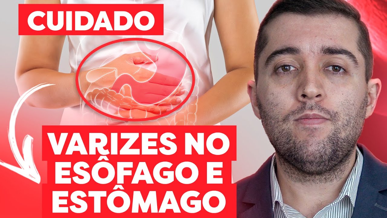 Varizes no esôfago e estômago: entenda a relação das doenças do fígado e a cirrose com estas varizes