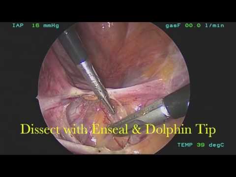 Laparoscopic Retropelvic Dissection