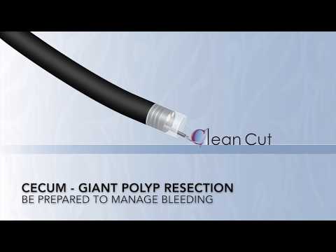 Colonoscopy: Cecum - Large Pedunculated Polyp Resection