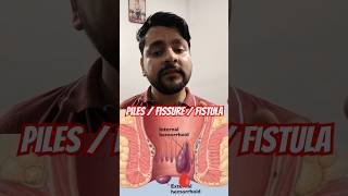 PILES Vs FISSURE Vs FISTULA : KEY DIFFERENCES EXPLAINED! 😱