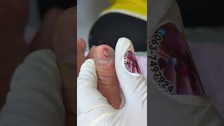 Ep_8298 Fingernails skin removal 👣 นั่น..สะกิดนิดเดียวออกมาเลย 😄 (clip from Thailand)