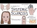 Systemic Sclerosis and Scleroderma: Visual Explanation for Students