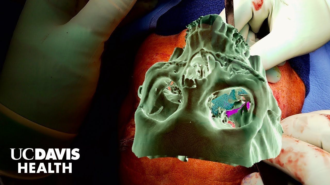 Thumbnail preview of Mixed Reality Goggles Guide Complex Surgeries - Driving Discovery