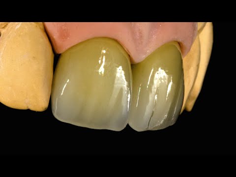 Нанесение GC MC INITIAL на 11|12 зубы