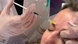 Cómo aplicar Botox para eliminar arrugas faciales y patas de gallo | Dermaforyou