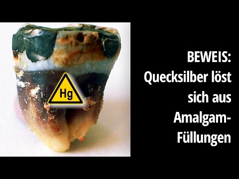 Amalgamentfernung: Quecksilber löst sich aus Amalgam (Deutsche Übersetzung)