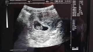 ASI SE VE UN EMBARAZO DE 8 SEMANAS DE GESTACIÓN, EMBRIÓN DE 8 SEMANAS, EMBARAZO DE 2 MESES.