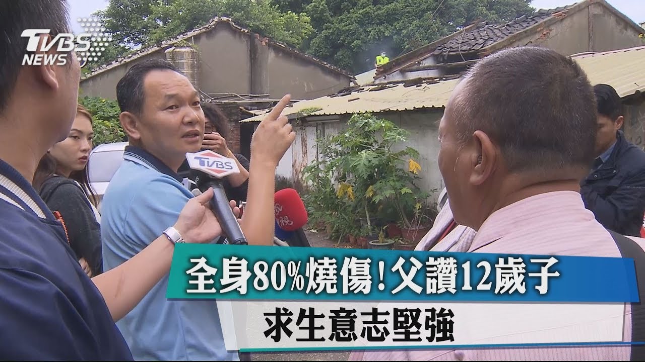 全身80%燒傷!父讚12歲子 求生意志堅強