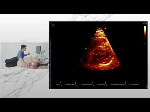 Standardisierte Echokardiographie - hypertrophe Kardiomyopathie (gesamte TTE Untersuchung) 💫 💟