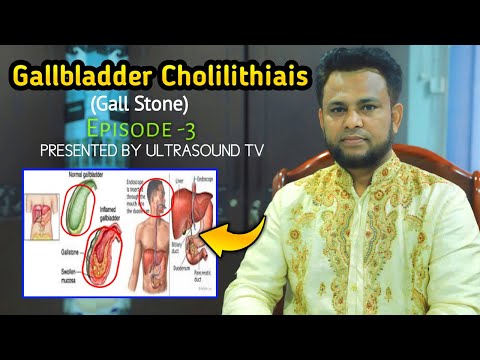 Gallbladder  Cholilithiais   (Gall Stone) Episode -3. PRESENTED BY ULTRASOUND TV