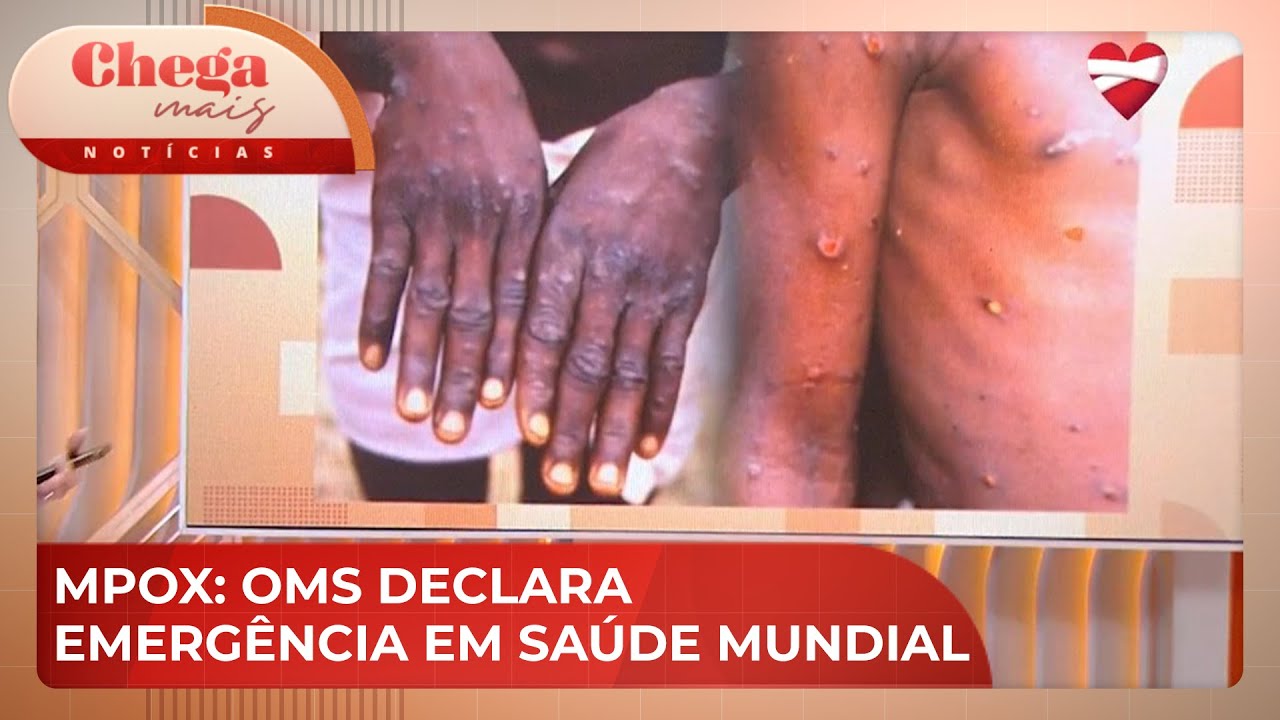 Mpox: Saiba quais são os sintomas e o tratamento da doença | Chega Mais Notícias (19/08/24)