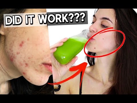 download lagu mp3 mp4 Celery Juice For Cystic Acne, download lagu Celery Juice For Cystic Acne gratis, unduh video klip Celery Juice For Cystic Acne
