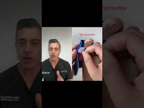 Bunion Corrector! Does it works?
