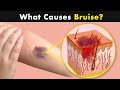 Bruises - Why does it happens? | Symptoms, Causes and treatment (Urdu/Hindi)