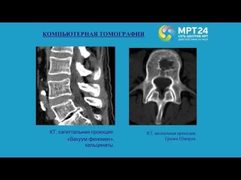 Боль в спине ниже лопаток вдоль позвоночника Может ли болеть глаз от шейного остеохондроза